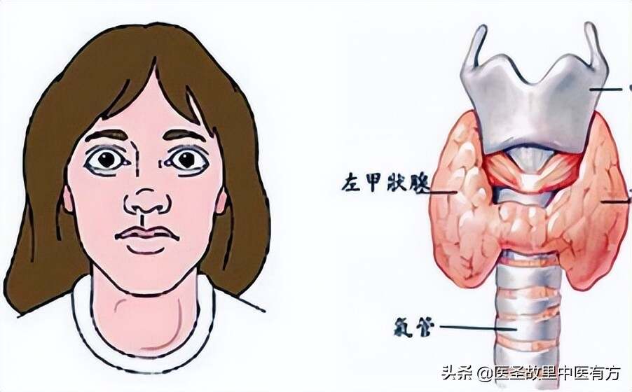 最新甲狀腺功能亢進癥治療方法