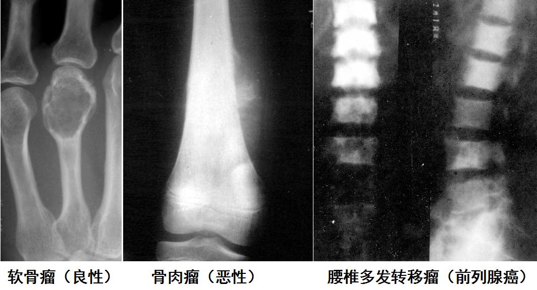 肺炎最新深度解析