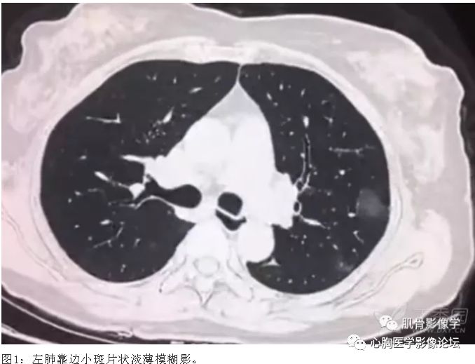 冠狀肺炎最新動態(tài)與最新進(jìn)展??